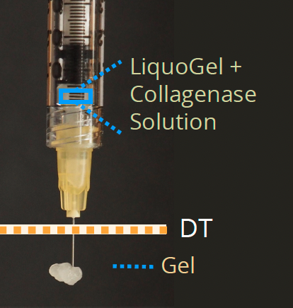 Liquogel + collagenase solution to treat uterine fibroids