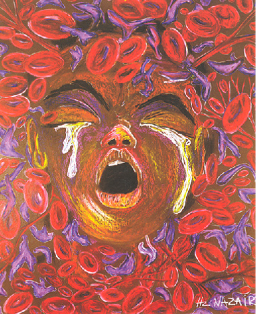 Artistic rendering of a brown person crying in pain surrounded by deformed red blood cells