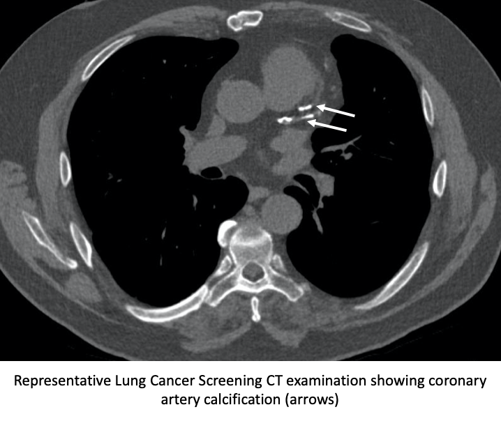 Representative lung cancer screening CT examination showing coronary artery calcification