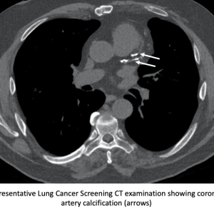 Representative lung cancer screening CT examination showing coronary artery calcification